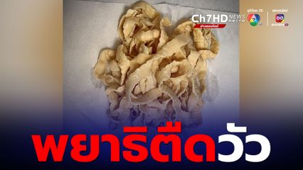 ชอบกินเนื้อวัวดิบ โปรดระวัง “พยาธิตืดวัว” ศูนย์วิจัยโรคปรสิต เผยภาพได้มาจากผู้ป่วยรายเดียว