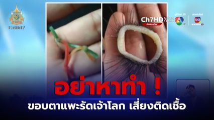 อย่าหาทำ ! ขอบตาแพะรัดเจ้าโลก เสี่ยงติดเชื้อ