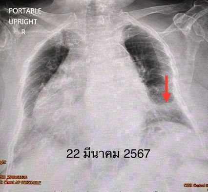 หมอมนูญเตือน ไรโนไวรัส ช่วงนี้พบบ่อยมาก