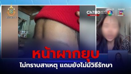 แชร์ประสบการณ์ หน้าผากยุบ ไม่ทราบสาเหตุ  แถมยังไม่มีวิธีรักษา 