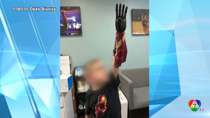 บริษัทหุ่นยนต์ผลิตแขนเทียม ไอออน แมน ให้เด็กพิการแต่กำเนิด