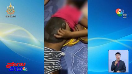 เด็กชายป่วย โรคไฝยักษ์ ได้รับการรักษาฟรี