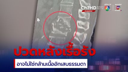 หมอยกเคสเตือนปวดหลังเรื้อรัง อย่าคิดว่าแค่กล้ามเนื้ออักเสบธรรมดา