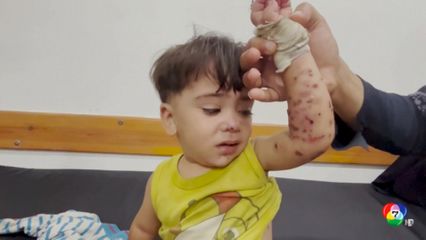 เด็กส่วนใหญ่ในฉนวนกาซาป่วยเป็นโรคผิวหนังรุนแรง