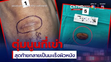 ตุ่มนูน แผลที่หัวเข่า กลายเป็นมะเร็งผิวหนัง