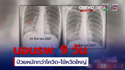 อายุ 29 ปี ติดเชื้อแบคทีเรียไมโคพลาสมา ป่วยหนักกว่าโควิด ไข้หวัดใหญ่