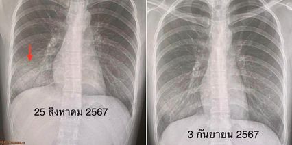 อายุ 29 ปี ติดเชื้อแบคทีเรียไมโคพลาสมา ป่วยหนักกว่าโควิด ไข้หวัดใหญ่