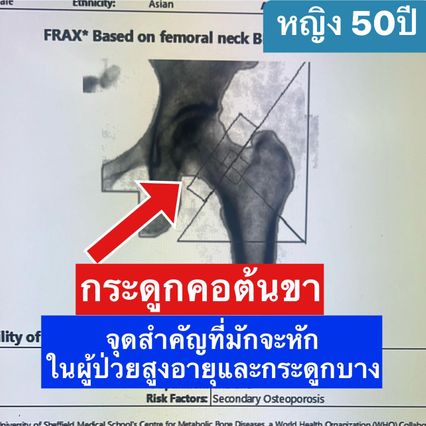 กระดูกคอต้นขาหัก เสี่ยงเสียชีวิตเทียบเท่ามะเร็ง
