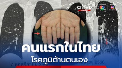 โรคภูมิต้านตนเอง หมอมนูญเตือนใครเกิดโรคนี้ห้ามฉีด mRNA เข็มต่อไป