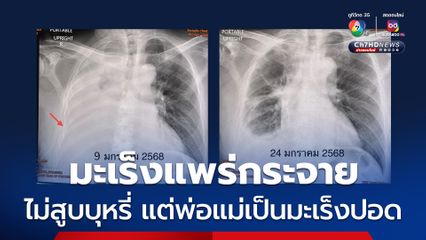 มะเร็งแพร่กระจาย ผู้ป่วยไม่สูบบุหรี่ แต่พ่อแม่เป็นมะเร็งปอด