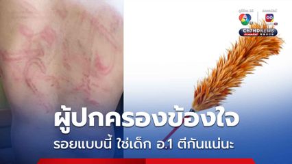 ผู้ปกครองข้องใจ แผลบนหลังลูก ใช่เด็ก อ.1 ตีกันแน่นะ