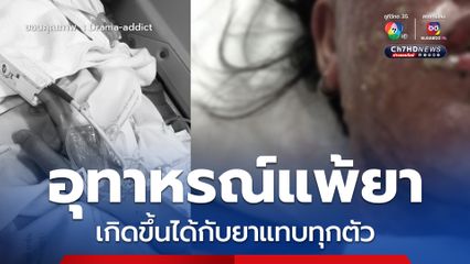สาวแชร์อุทาหรณ์แพ้ยารุนแรง นอน ICU 36 วัน