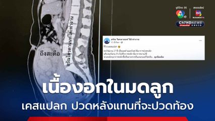 ปวดหลังร้าวลงก้น เคสแปลกเนื้องอกในมดลูก ใหญ่เท่าเด็ก 5 เดือน