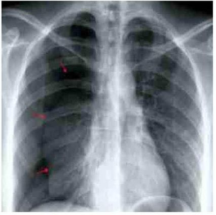 ภาวะปอดรั่ว ช่วงมีรอบเดือน ผู้ป่วยมีอการเหนื่อย เจ็บอกขวาทันทีทันใด