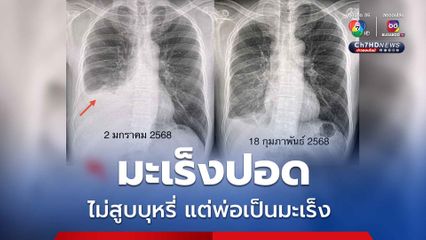 หมอมนูญ ยกเคสผู้ป่วยไม่เคยสูบบุหรี่ แต่พ่อเป็นมะเร็ง ตรวจพบมะเร็งปอด