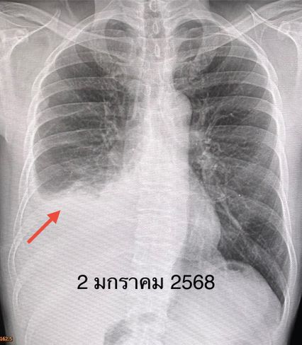 หมอมนูญ ยกเคสผู้ป่วยไม่เคยสูบบุหรี่ แต่พ่อเป็นมะเร็ง ตรวจพบมะเร็งปอด