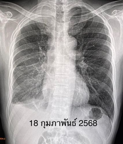 หมอมนูญ ยกเคสผู้ป่วยไม่เคยสูบบุหรี่ แต่พ่อเป็นมะเร็ง ตรวจพบมะเร็งปอด
