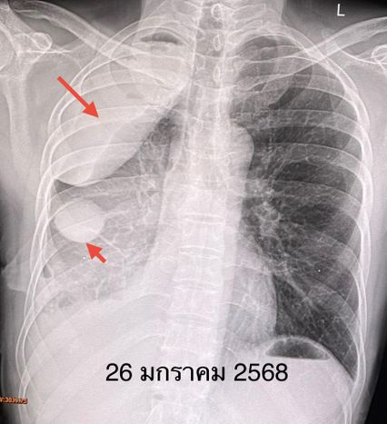 หมอมนูญ ยกเคสผู้ป่วยไม่เคยสูบบุหรี่ แต่พ่อเป็นมะเร็ง ตรวจพบมะเร็งปอด