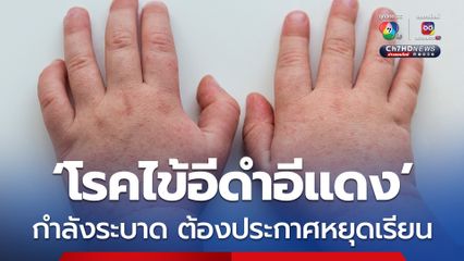 หมอแล็บแพนด้า โพสต์เตือน ‘โรคไข้อีดำอีแดง’ กำลังระบาด ต้องประกาศหยุดเรียน พร้อมเผยอาการและวิธีรักษา