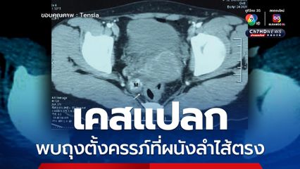 เคสแปลก หญิงวัย 32 ปี เลือดออกช่องคลอด ตรวจเพิ่มเติมพบตั้งครรภ์ แต่หายังไงก็ไม่เจอว่าตั้งครรภ์ที่ไหน สุดท้ายถึงพบ ถุงตั้งครรภ์ที่ผนังลำไส้ตรง