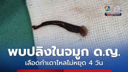 พบปลิงในโพรงจมูก ด.ญ. 3 ขวบ เลือดกำเดาไหลไม่หยุด 4 วัน