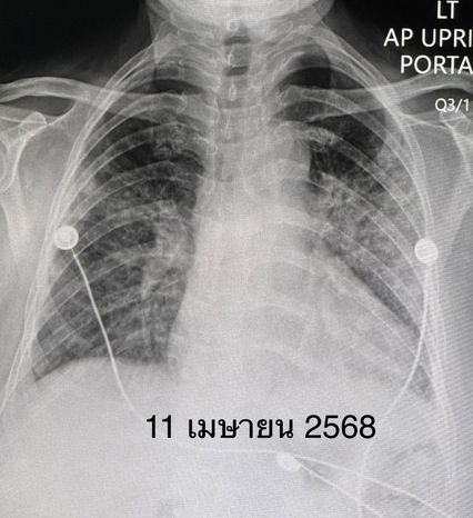 ปอดอักเสบทั้ง 2 ข้าง จากโรคภูมิต้านทานตนเอง