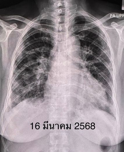 ปอดอักเสบทั้ง 2 ข้าง จากโรคภูมิต้านทานตนเอง