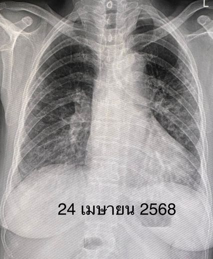 ปอดอักเสบทั้ง 2 ข้าง จากโรคภูมิต้านทานตนเอง