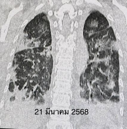 ปอดอักเสบทั้ง 2 ข้าง จากโรคภูมิต้านทานตนเอง