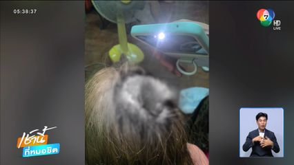 สาวฟอกสีผม หนังศีรษะเป็นแผลติดเชื้อ