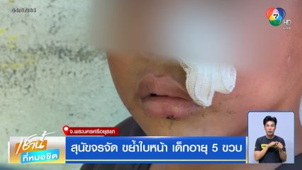 สุนัขจรจัด ขย้ำใบหน้า เด็กอายุ 5 ขวบ