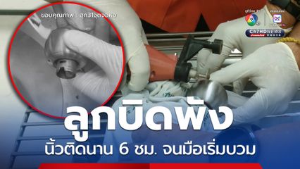 ลูกบิดประตูพัง เด็กผู้หญิงใช้นิ้วแหย่ นิ้วติดในลูกบิดนาน 6 ชม.