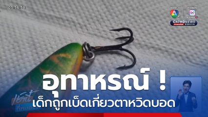 อุทาหรณ์ ! เด็กถูกเบ็ดเกี่ยวตาหวิดบอด