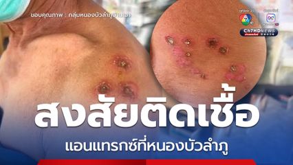 หนองบัวลำภูพบผู้ป่วยสงสัยแอนแทรกซ์ ชำแหละวัว-กินลาบดิบ