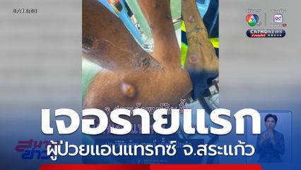 เจอรายแรก ผู้ป่วยแอนแทรกซ์ จ.สระแก้ว