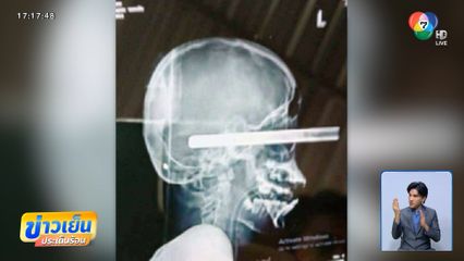 ปืนระเบิดใส่วัยรุ่น ลำกล้องปักตายังสาหัส