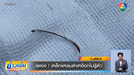 สุดงง ! เหล็กแหลมตำเหงือกไม่รู้ตัว