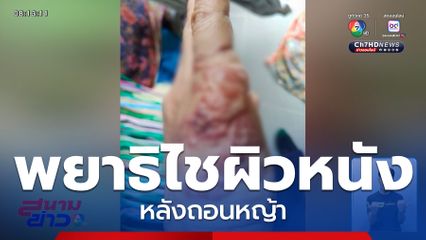 สยอง พยาธิไชผิวหนัง หลังถอนหญ้า