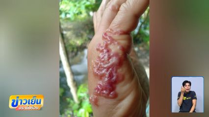 ขนลุก ! พยาธิไชผิวหนัง