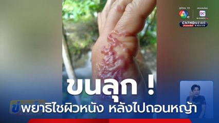 ขนลุก ! พยาธิไชผิวหนัง