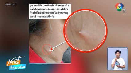 หวาดเสียว ก้างปลาแทงทะลุคอ