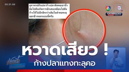 หวาดเสียว ก้างปลาแทงทะลุคอ