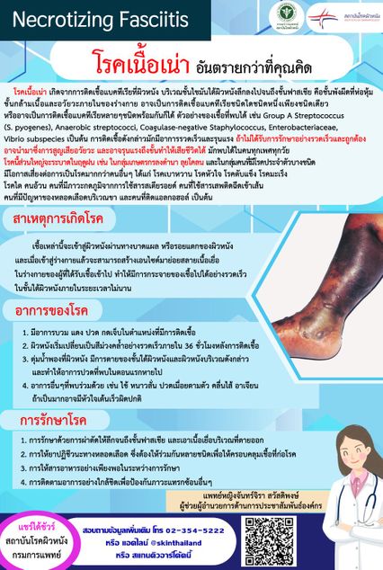 รู้จักโรคแบคทีเรียกินเนื้อคน กรณีชายเสียชีวิตปริศนาบนรถทัวร์