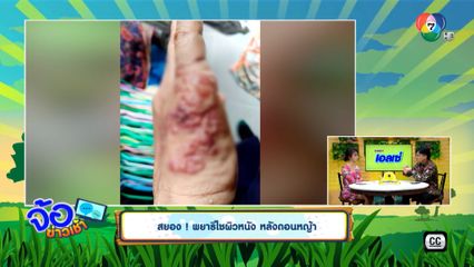 สยอง ! พยาธิไชผิวหนัง หลังถอนหญ้า