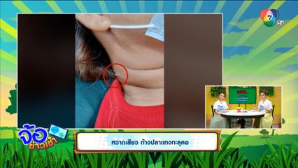 หวาดเสียว ก้างปลาแทงทะลุคอ