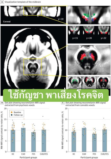 อจ.หมอสุรัตน์ ยกผลวิจัยยืนยันใช้กัญชาก่อเกิดโรคจิต