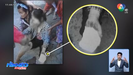 วิทยุปริศนา ระเบิดใส่หญิงอายุ 60 ปี บาดเจ็บ