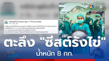 ผ่าตัด "ซีสต์รังไข่" น้ำหนัก 8 กก.