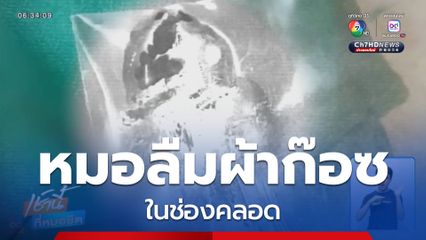 หมอลืมผ้าก๊อซ ทำติดเชื้อเรื้อรัง