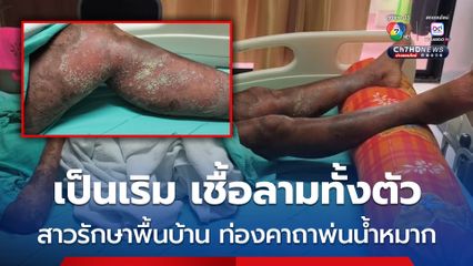 อุทาหรณ์ สาวแม่ค้าขายผักป่วยเป็นเริม รักษาพื้นบ้าน ท่องคาถาพ่นน้ำหมาก เชื้อลามทั้งตัว ติดเชื้อในกระแสเลือด